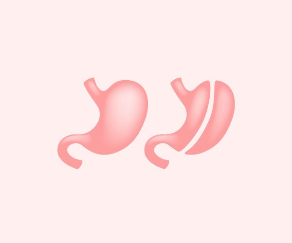 Sleeve Gastrectomy Sleeve Gastrectomy