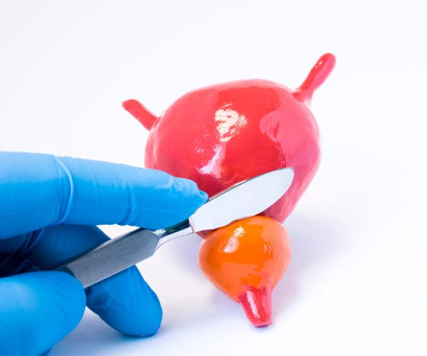 Transurethral Resection of the Prostate