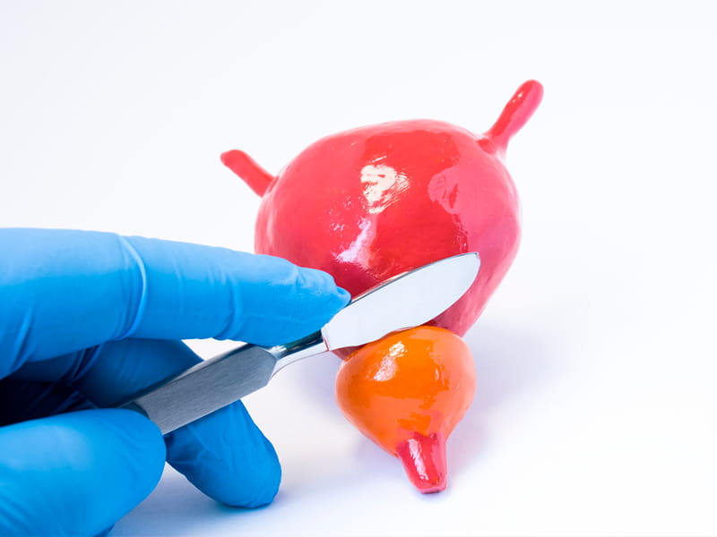 Transurethral resection of the prostate (turp) 10 Transurethral resection of the prostate