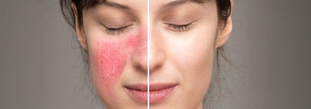 Rosacea