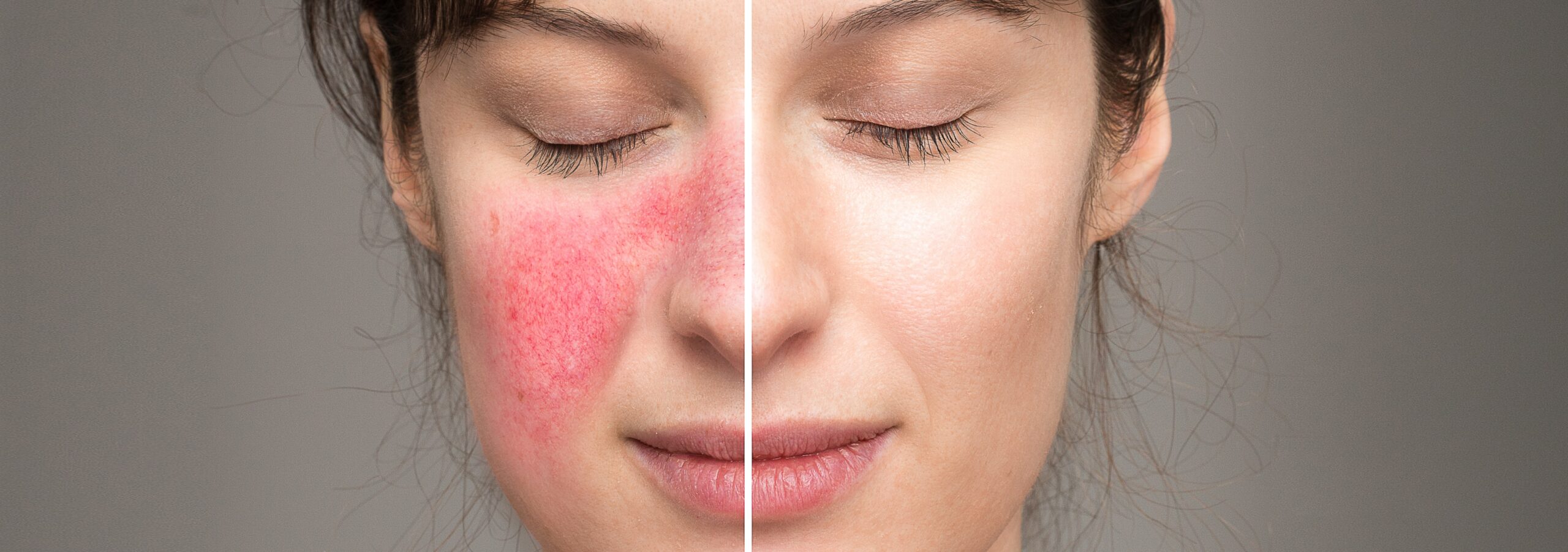 rosacea