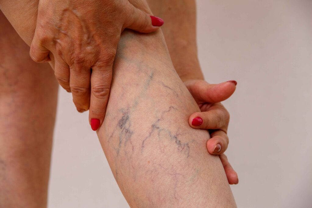 Varicose Vein Treatment