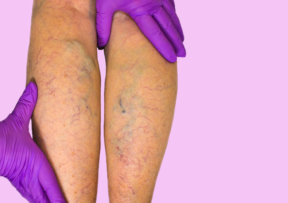 Venous insufficiency treatment
